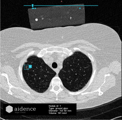 Kuva 2: Konenäkö on merkinnyt ja myös mitannut noduulin potilaan keuhkokuvista
