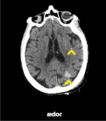 Kuva 1: Konenäkö on tunnistanut ja merkinnyt kaksi tiivistymää potilaan aivokudoksessa